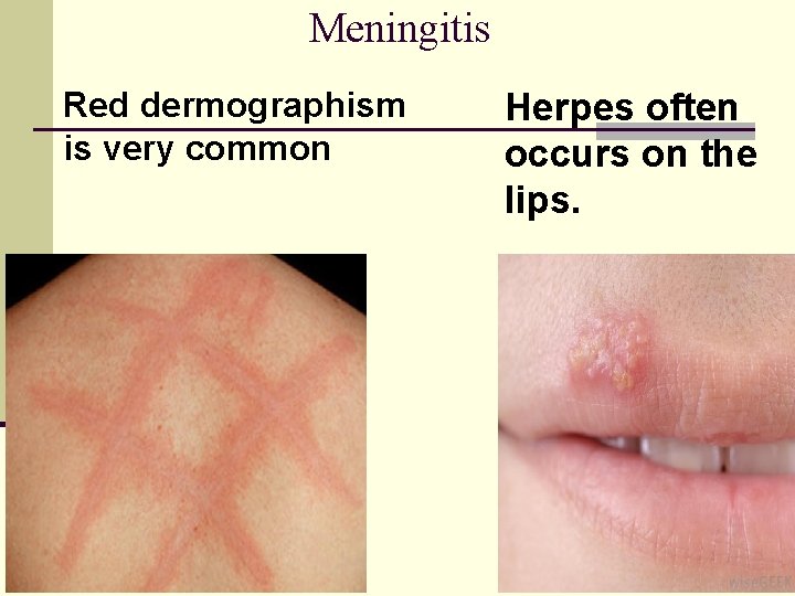 Meningitis Red dermographism is very common Herpes often occurs on the lips. 