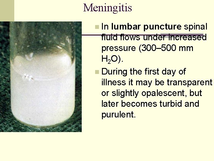 Meningitis n In lumbar puncture spinal fluid flows under increased pressure (300– 500 mm