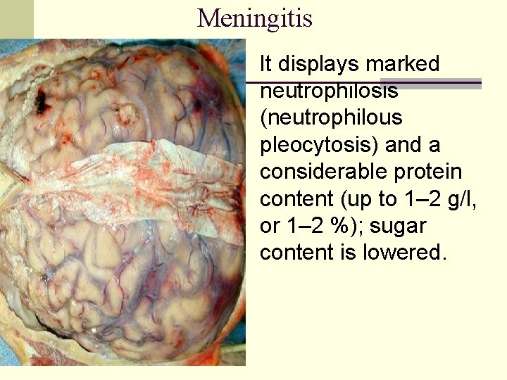 Meningitis It displays marked neutrophilosis (neutrophilous pleocytosis) and a considerable protein content (up to