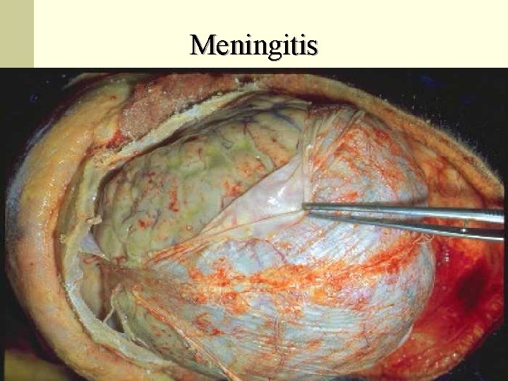 Meningitis 