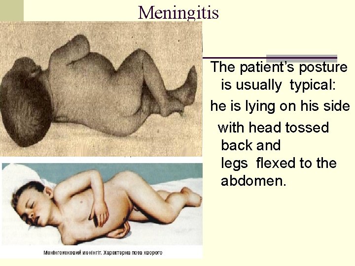 Meningitis The patient’s posture is usually typical: he is lying on his side with