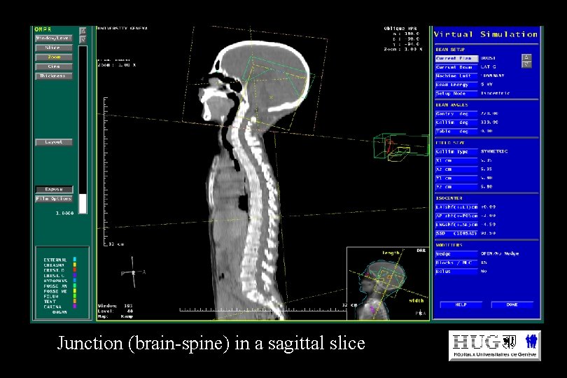 Junction (brain-spine) in a sagittal slice 