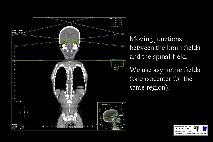 Moving junctions between the brain fields and the spinal field. We use asymetric fields