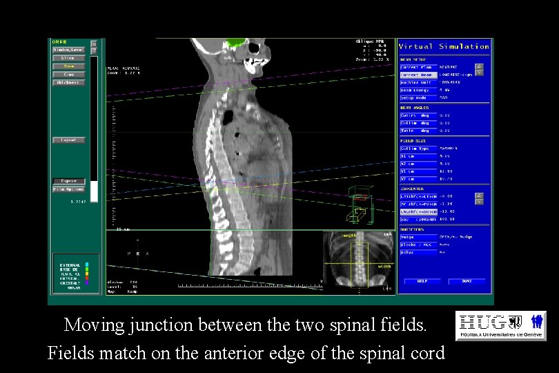 Moving junction between the two spinal fields. Fields match on the anterior edge of