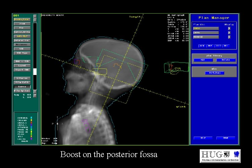 Boost on the posterior fossa Boost on the posterior fossa