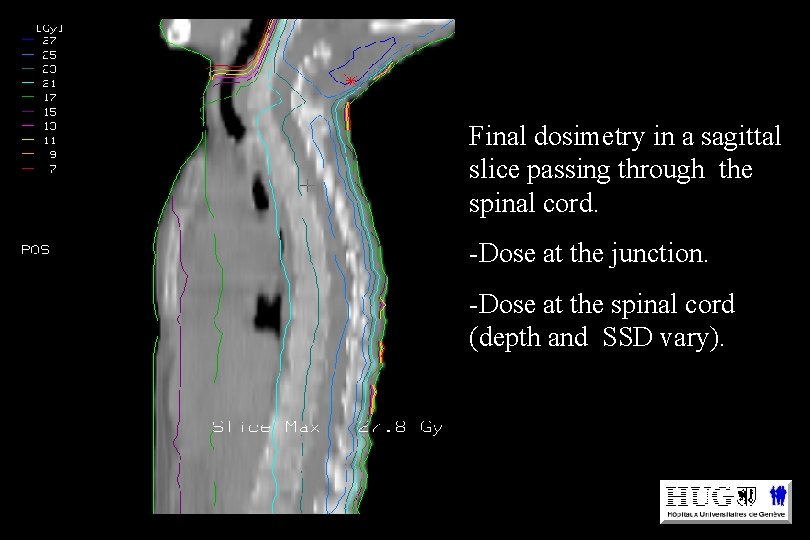 Final dosimetry in a sagittal slice passing through the spinal cord. -Dose at the Final dosimetry in a sagittal slice passing through the spinal cord. -Dose at the