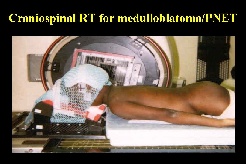 Craniospinal RT for medulloblatoma/PNET Craniospinal RT for medulloblatoma/PNET
