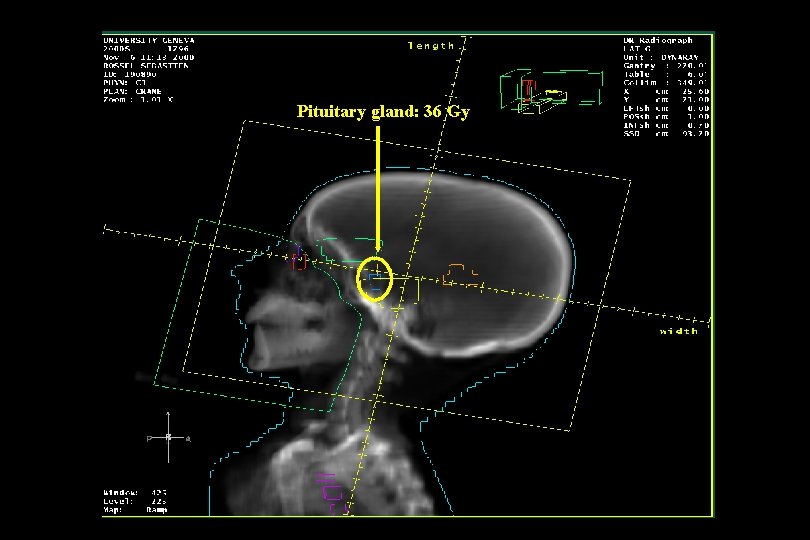 Pituitary gland: 36 Gy 