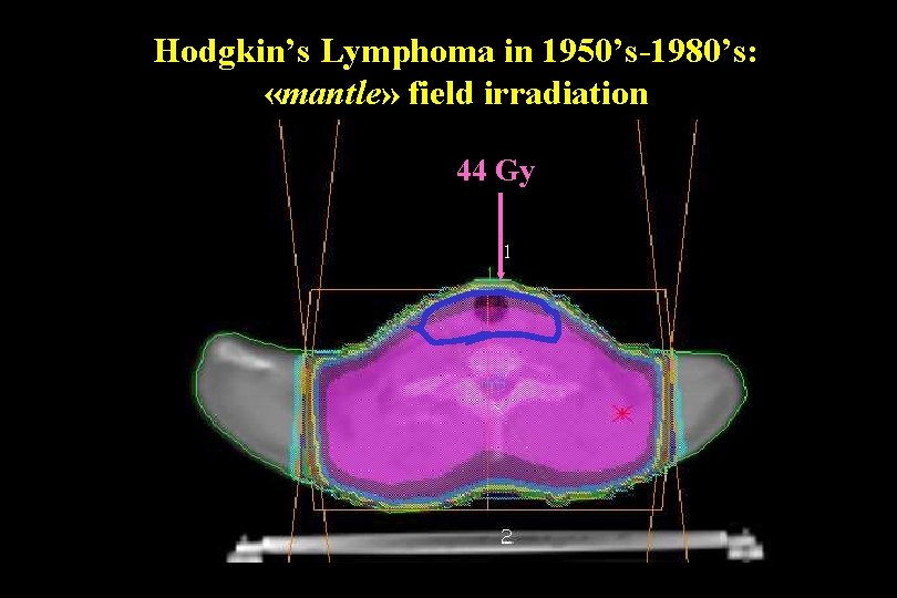 Hodgkin’s Lymphoma in 1950’s-1980’s: «mantle» field irradiation 44 Gy 