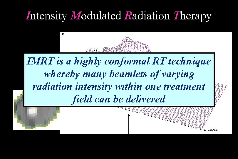 Intensity Modulated Radiation Therapy IMRT is a highly conformal RT technique whereby many beamlets