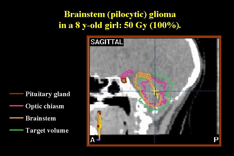 Brainstem (pilocytic) glioma in a 8 y-old girl: 50 Gy (100%). Pituitary gland Optic