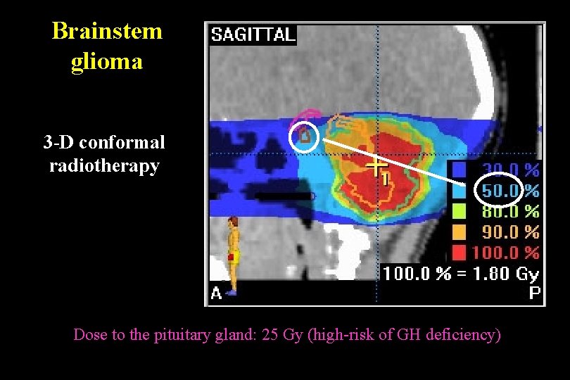 Brainstem glioma 3 -D conformal radiotherapy Dose to the pituitary gland: 25 Gy (high-risk