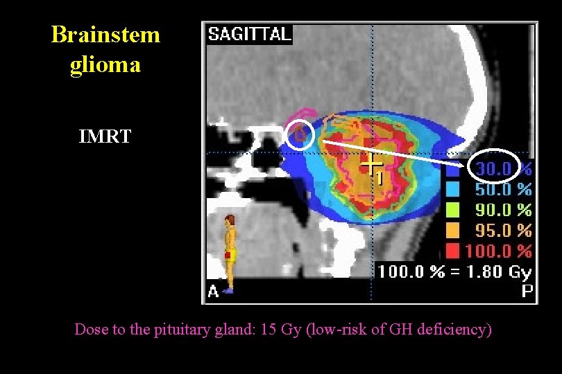 Brainstem glioma IMRT Dose to the pituitary gland: 15 Gy (low-risk of GH deficiency)