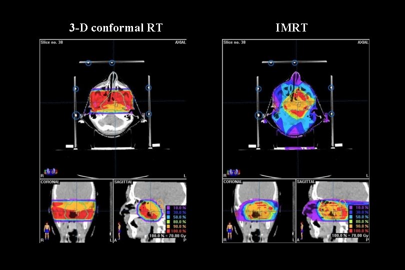 3 -D conformal RT IMRT 3 -D conformal RT IMRT