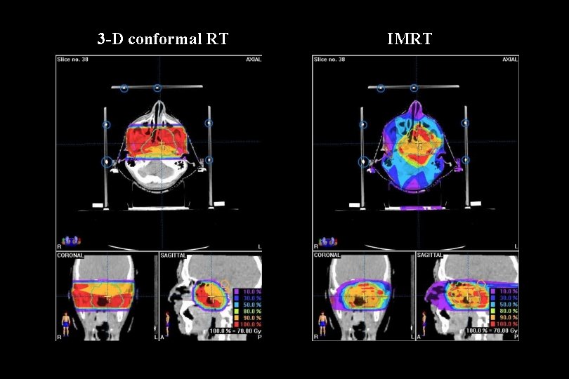 3 -D conformal RT IMRT 