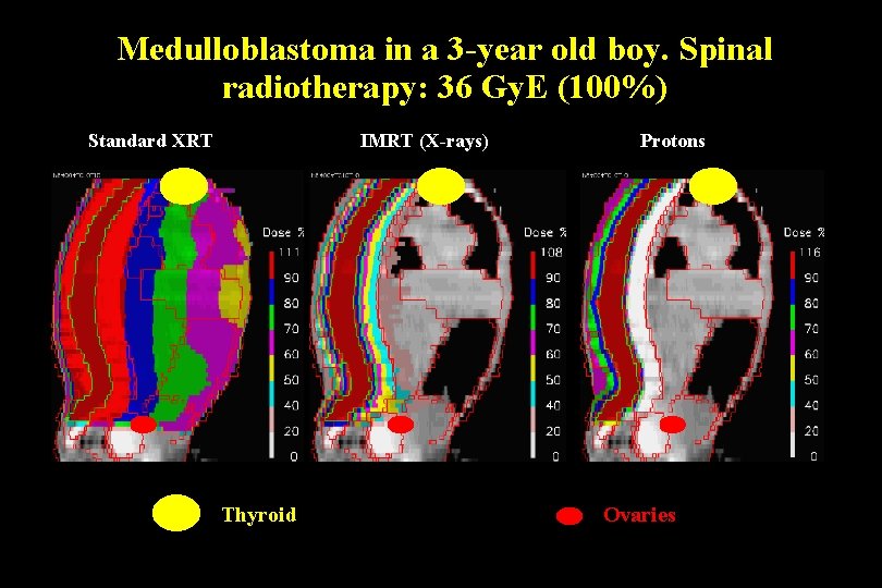 Medulloblastoma in a 3 -year old boy. Spinal radiotherapy: 36 Gy. E (100%) Standard