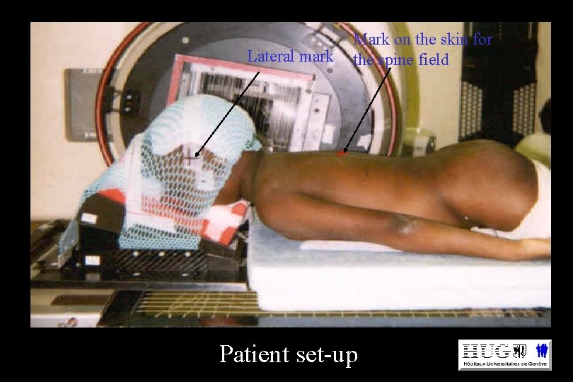 Lateral mark Mark on the skin for the spine field Patient set-up 