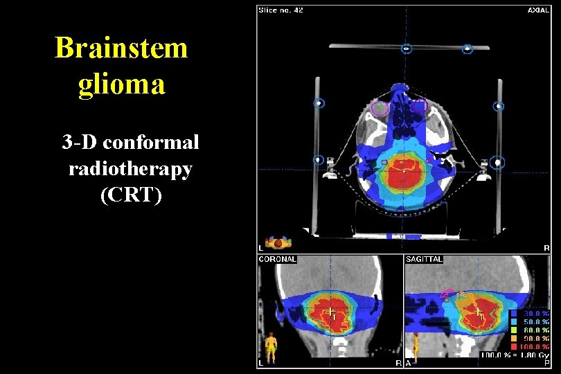 Brainstem glioma 3 -D conformal radiotherapy (CRT) 