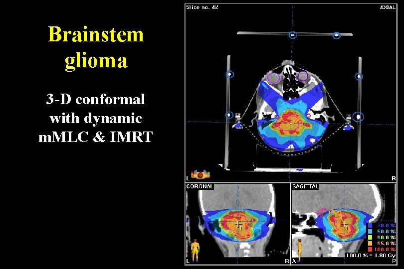 Brainstem glioma 3 -D conformal with dynamic m. MLC & IMRT Brainstem glioma 3 -D conformal with dynamic m. MLC & IMRT