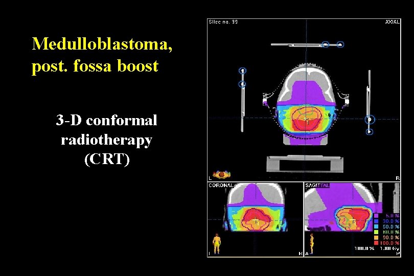 Medulloblastoma, post. fossa boost 3 -D conformal radiotherapy (CRT) 