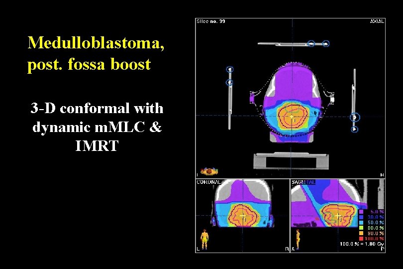 Medulloblastoma, post. fossa boost 3 -D conformal with dynamic m. MLC & IMRT Medulloblastoma, post. fossa boost 3 -D conformal with dynamic m. MLC & IMRT