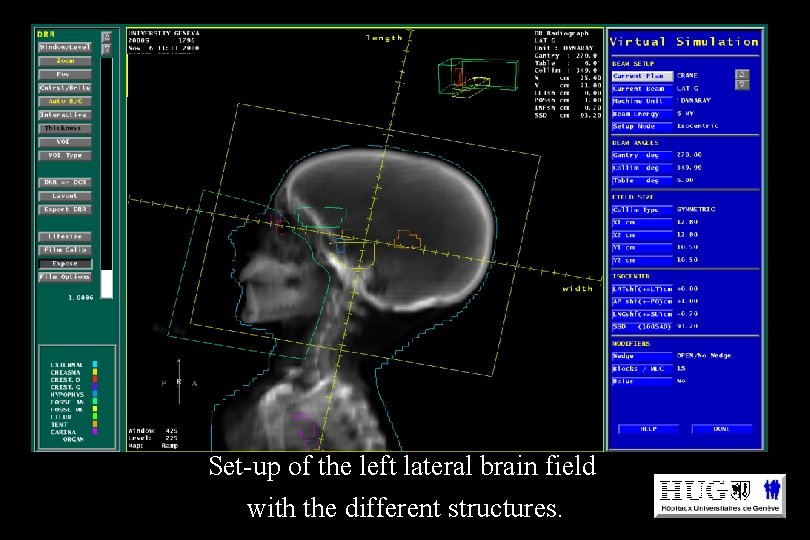 Set-up of the left lateral brain field with the different structures. 