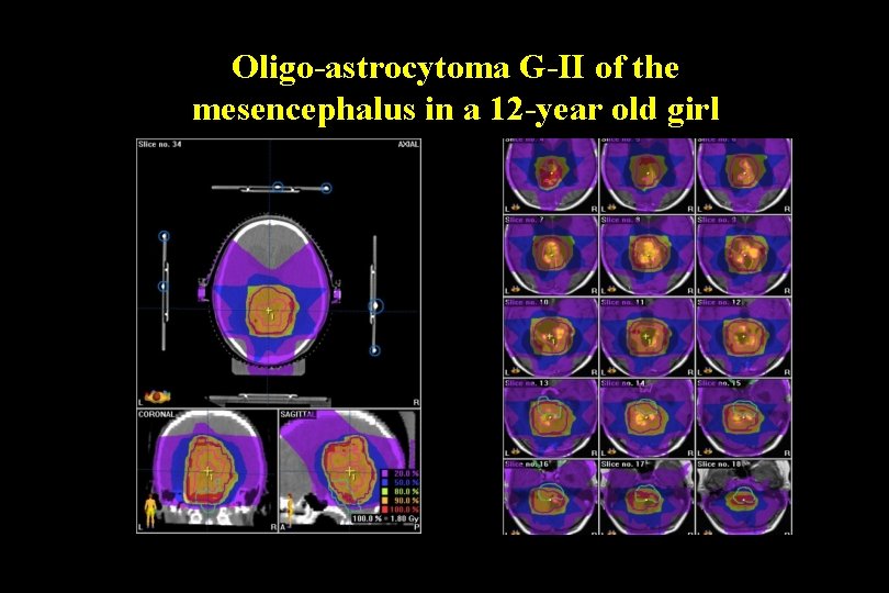 Oligo-astrocytoma G-II of the mesencephalus in a 12 -year old girl 