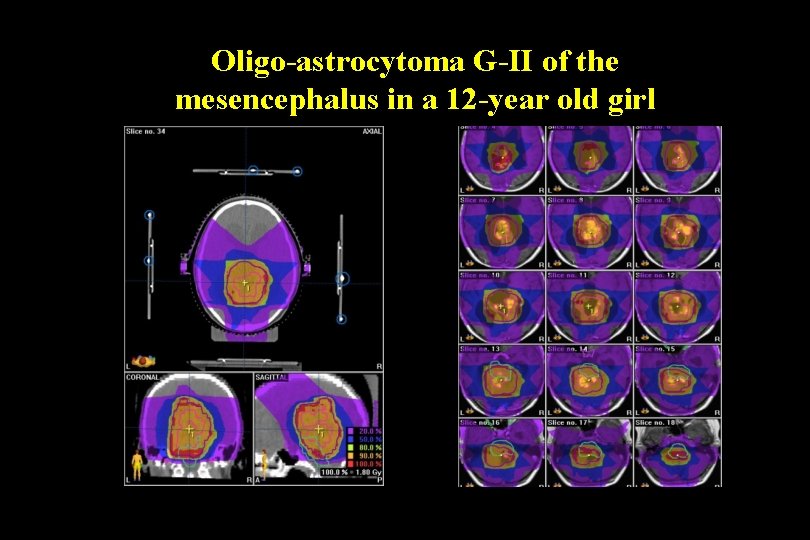 Oligo-astrocytoma G-II of the mesencephalus in a 12 -year old girl Oligo-astrocytoma G-II of the mesencephalus in a 12 -year old girl