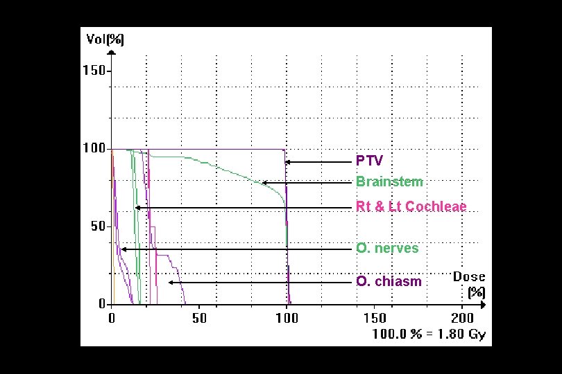 PTV Brainstem Rt & Lt Cochleae O. nerves O. chiasm 