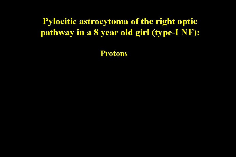 Pylocitic astrocytoma of the right optic pathway in a 8 year old girl (type-I