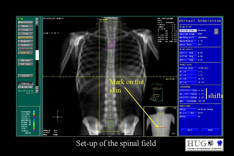 Mark on the skin Set-up of the spinal field shifts 