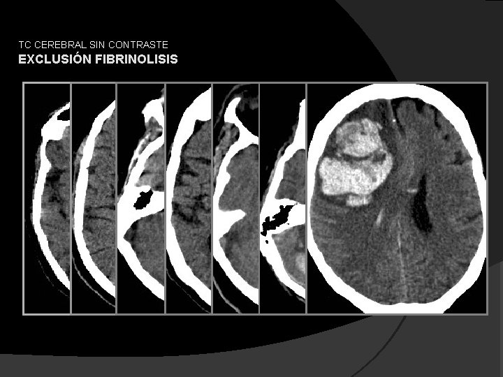 TC CEREBRAL SIN CONTRASTE EXCLUSIÓN FIBRINOLISIS 