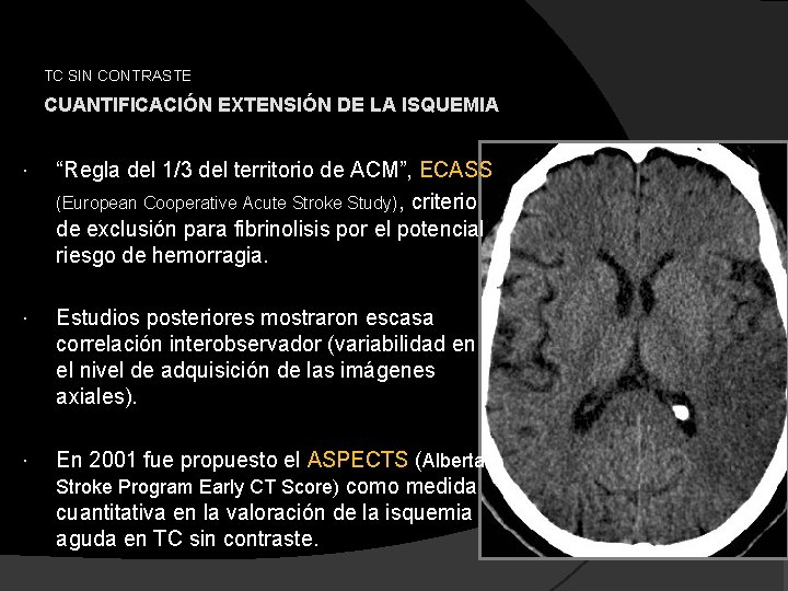 TC SIN CONTRASTE CUANTIFICACIÓN EXTENSIÓN DE LA ISQUEMIA “Regla del 1/3 del territorio de