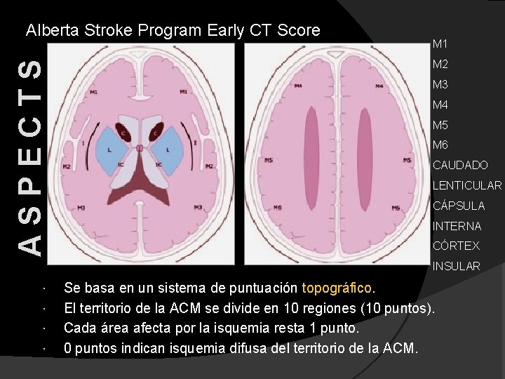 ASPECTS Alberta Stroke Program Early CT Score M 1 M 2 M 3 M