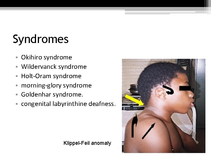 Syndromes • • • Okihiro syndrome Wildervanck syndrome Holt-Oram syndrome morning-glory syndrome Goldenhar syndrome.