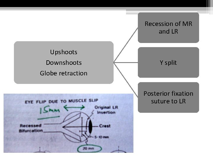 Recession of MR and LR Upshoots Downshoots Globe retraction Y split Posterior fixation suture