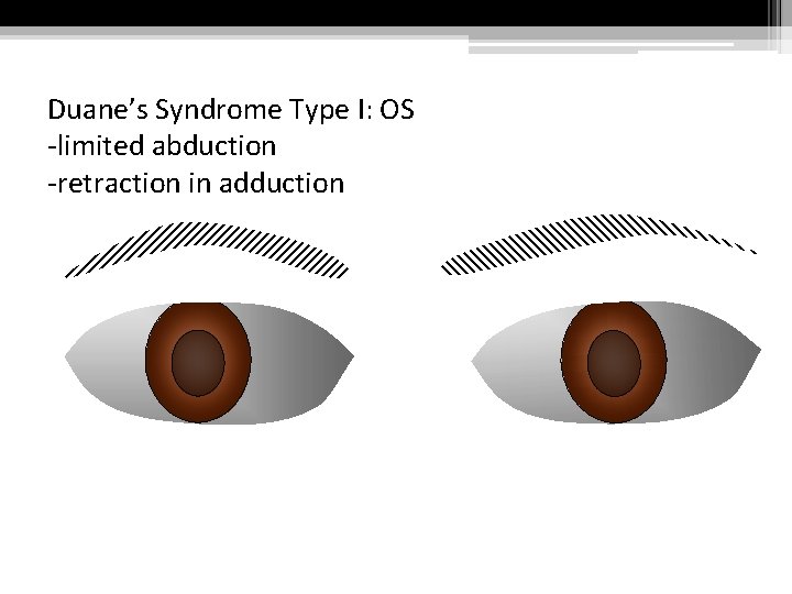 Duane’s Syndrome Type I: OS -limited abduction -retraction in adduction 