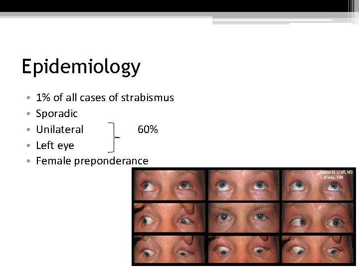 Epidemiology • • • 1% of all cases of strabismus Sporadic Unilateral 60% Left