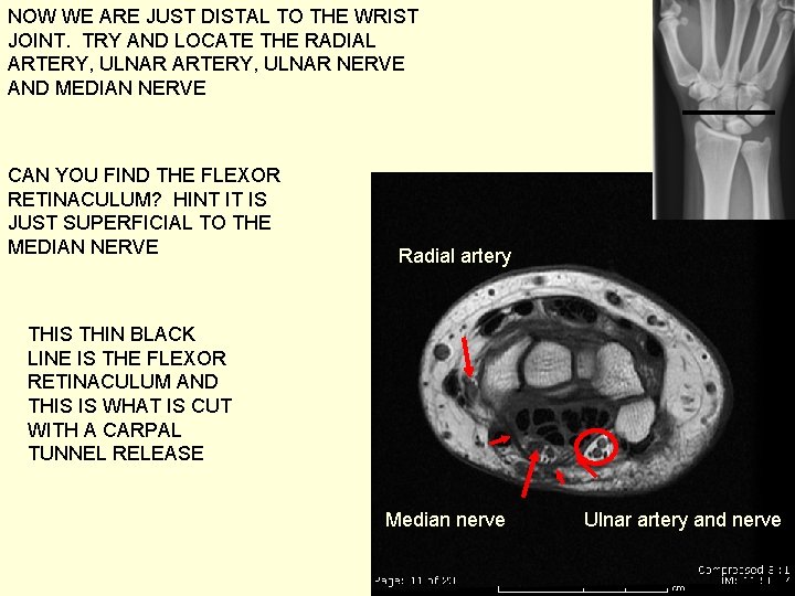 NOW WE ARE JUST DISTAL TO THE WRIST JOINT. TRY AND LOCATE THE RADIAL