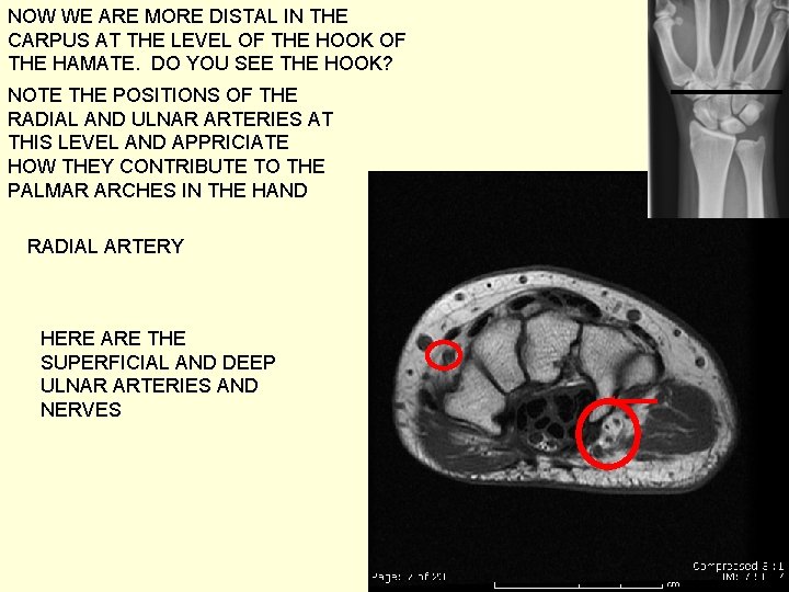 NOW WE ARE MORE DISTAL IN THE CARPUS AT THE LEVEL OF THE HOOK