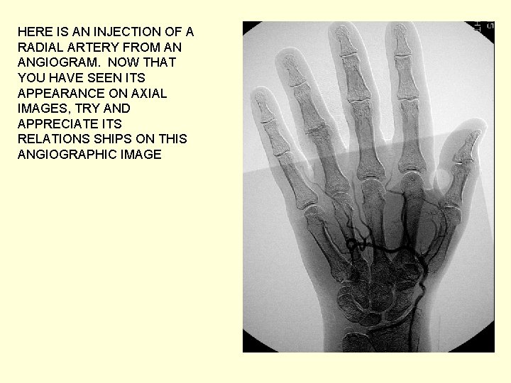 HERE IS AN INJECTION OF A RADIAL ARTERY FROM AN ANGIOGRAM. NOW THAT YOU