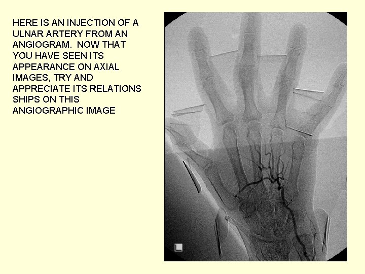 HERE IS AN INJECTION OF A ULNAR ARTERY FROM AN ANGIOGRAM. NOW THAT YOU