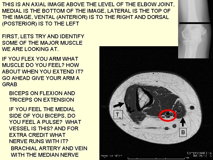 THIS IS AN AXIAL IMAGE ABOVE THE LEVEL OF THE ELBOW JOINT, MEDIAL IS