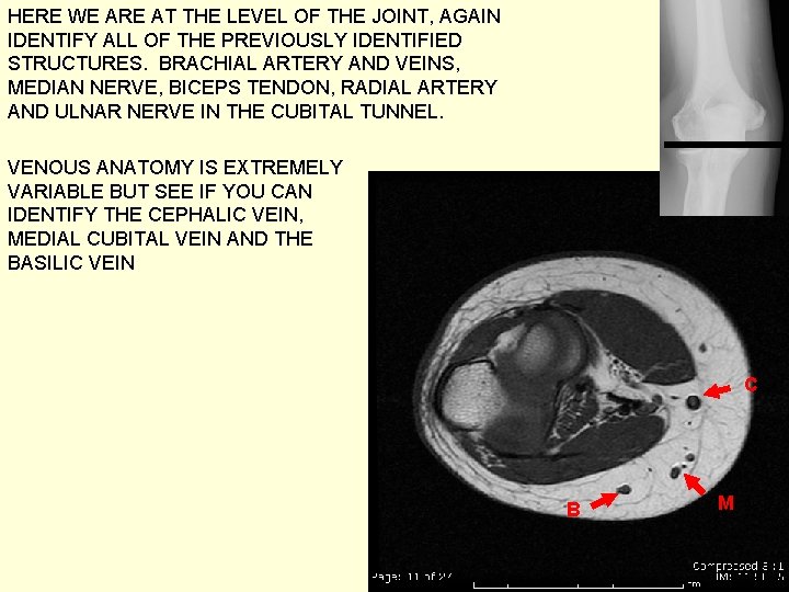 HERE WE ARE AT THE LEVEL OF THE JOINT, AGAIN IDENTIFY ALL OF THE