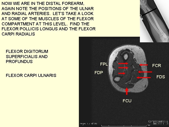 NOW WE ARE IN THE DISTAL FOREARM, AGAIN NOTE THE POSITIONS OF THE ULNAR