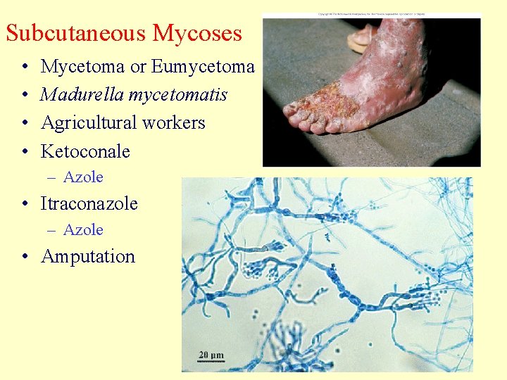 Subcutaneous Mycoses • • Mycetoma or Eumycetoma Madurella mycetomatis Agricultural workers Ketoconale – Azole