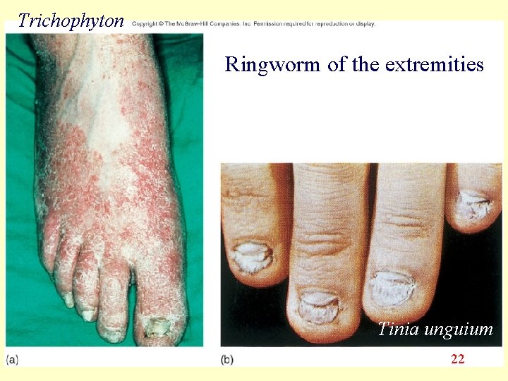 Trichophyton Ringworm of the extremities Tinia unguium 22 