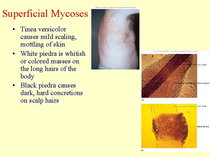 Superficial Mycoses • Tinea versicolor causes mild scaling, mottling of skin • White piedra