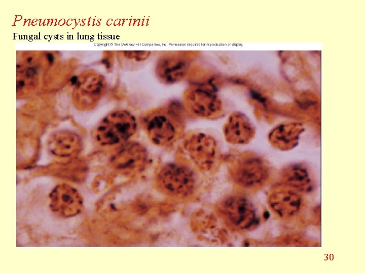 Pneumocystis carinii Fungal cysts in lung tissue 30 
