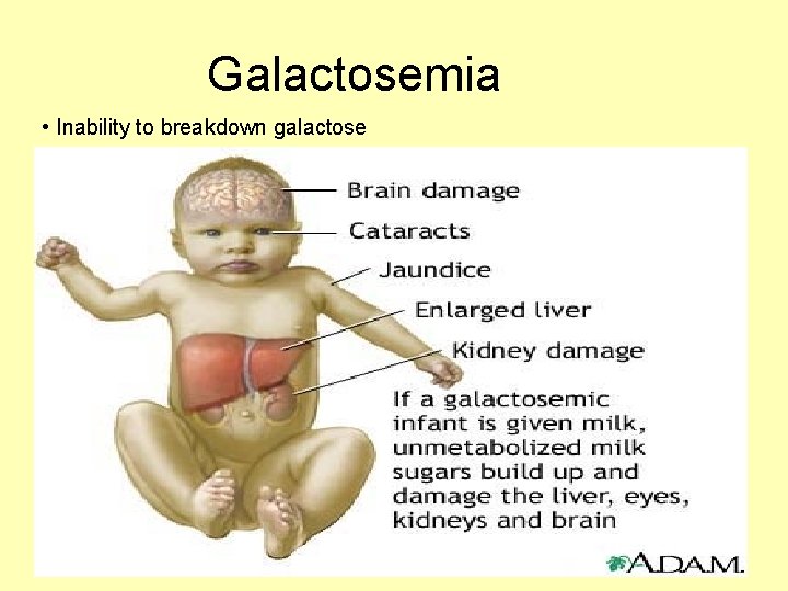 Galactosemia • Inability to breakdown galactose 